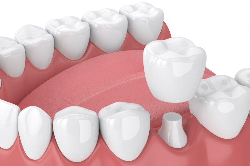 Dental Crowns in Watsonville