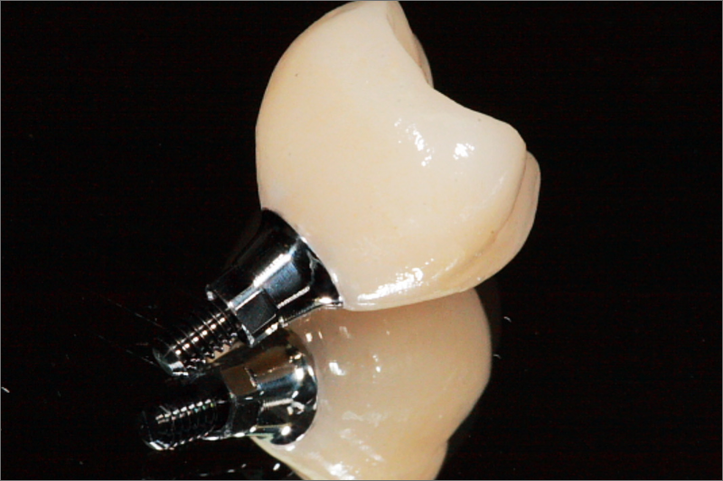 Implants Dentist in Watsonville