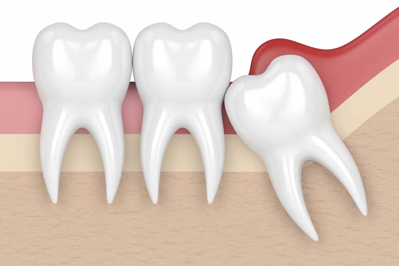 Wisdom Tooth Removal in Watsonville